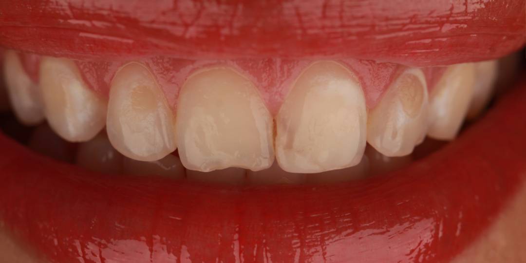 <span class="bt_bb_before_after_image_before_text"> Antes</span>