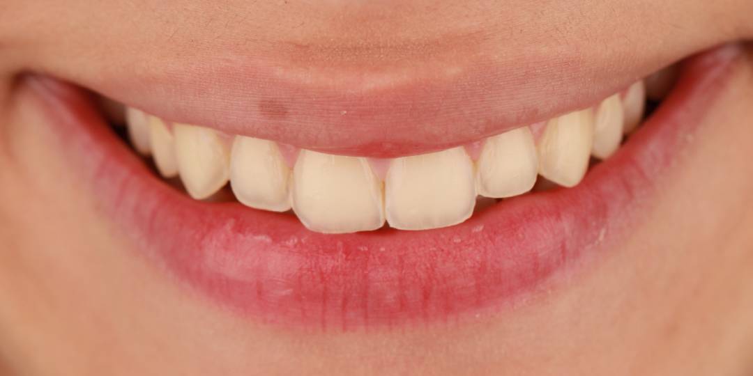 <span class="bt_bb_before_after_image_before_text"> Antes</span>