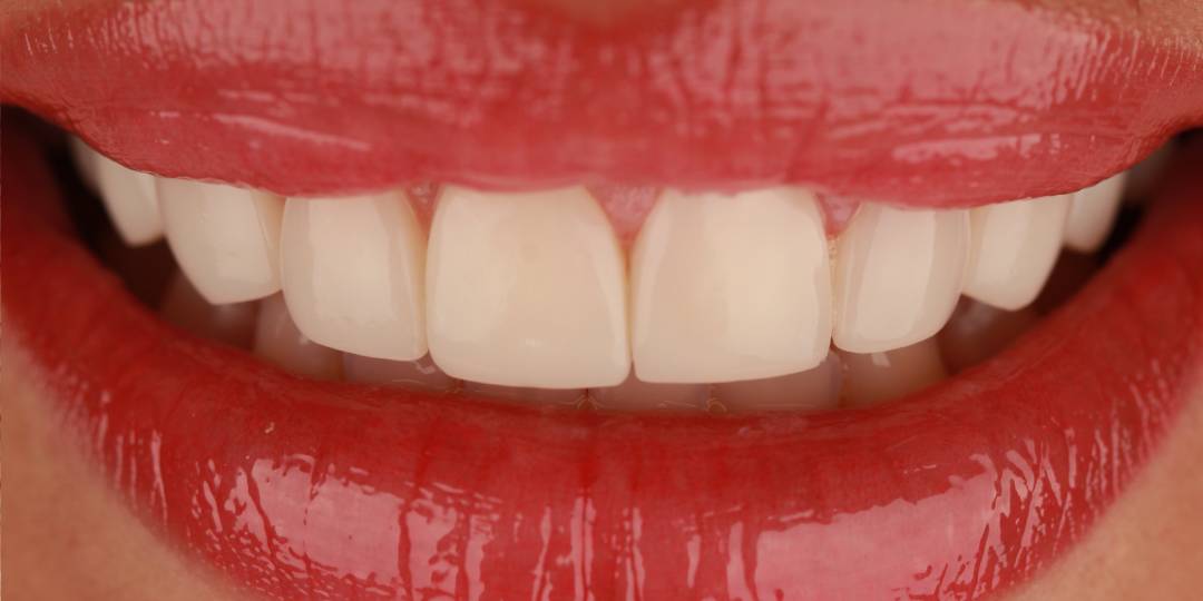 <span class="bt_bb_before_after_image_after_text"> Después</span>