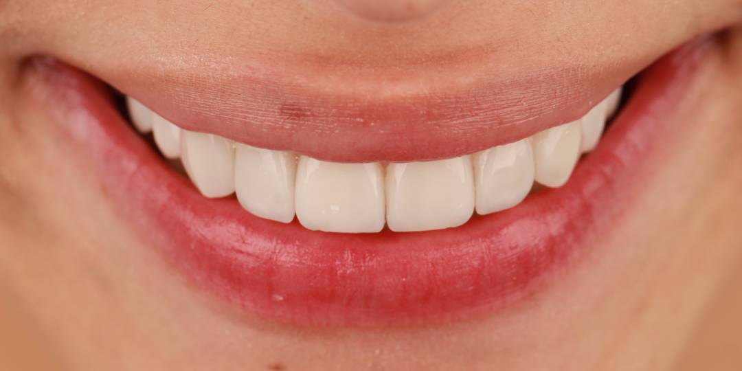 <span class="bt_bb_before_after_image_after_text"> Después</span>